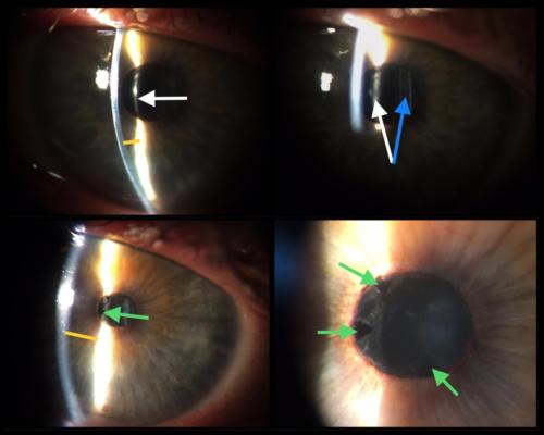 Pupillary block caused by fibrin membrane after  cataract surgery